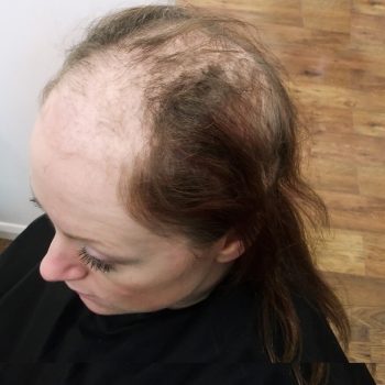 Trichotillomania And Hair Loss Find Out How Our Hair System Can Help